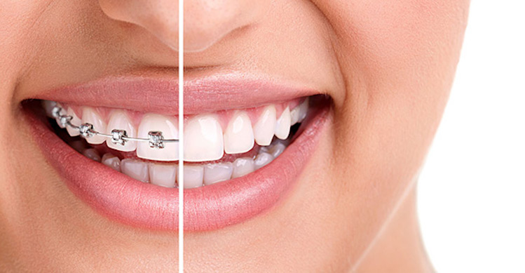 Orthodontics and Braces